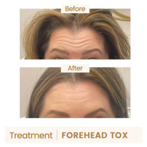 forehead-tox2-before-after