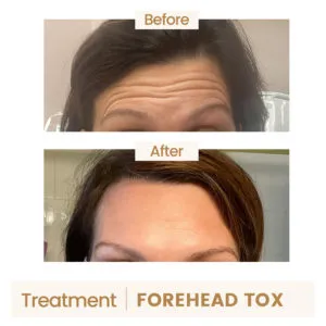 Grand Beauty Solutions, LLC_B_A_Forehead Tox three