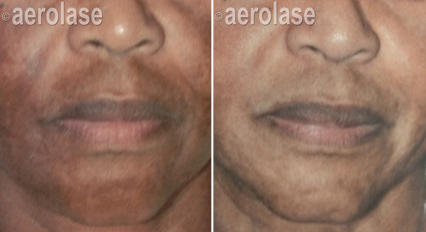 Melasma2 - Pair