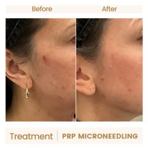 PRP-Microneedling