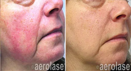 Rosacea1 - Pair