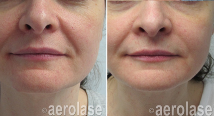 Skin Rejuvenation6 - Pair