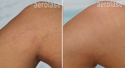 Spider Veins1 - Pair