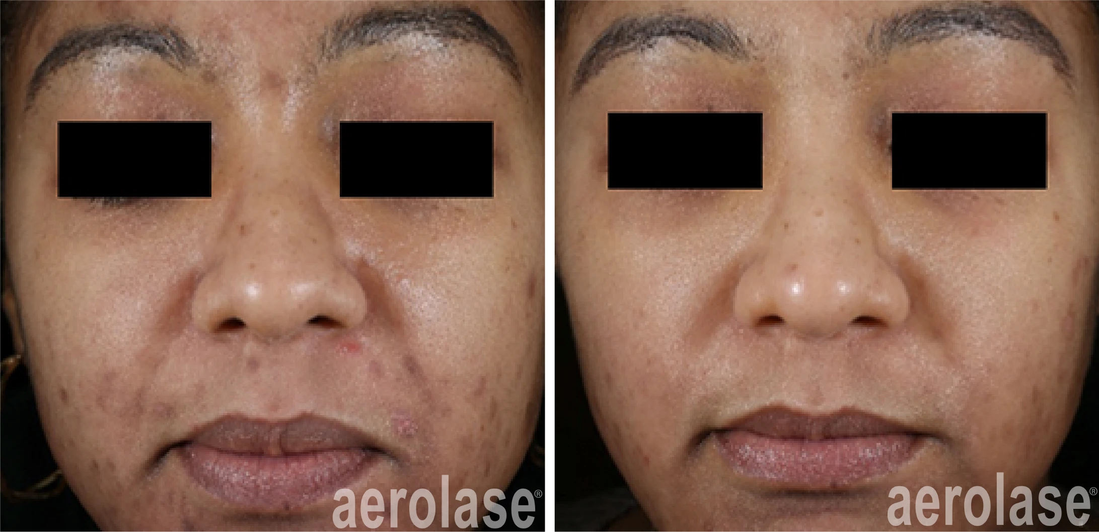 NeoClear Acne - 5 Months After 3 Treatments - David Goldberg MD