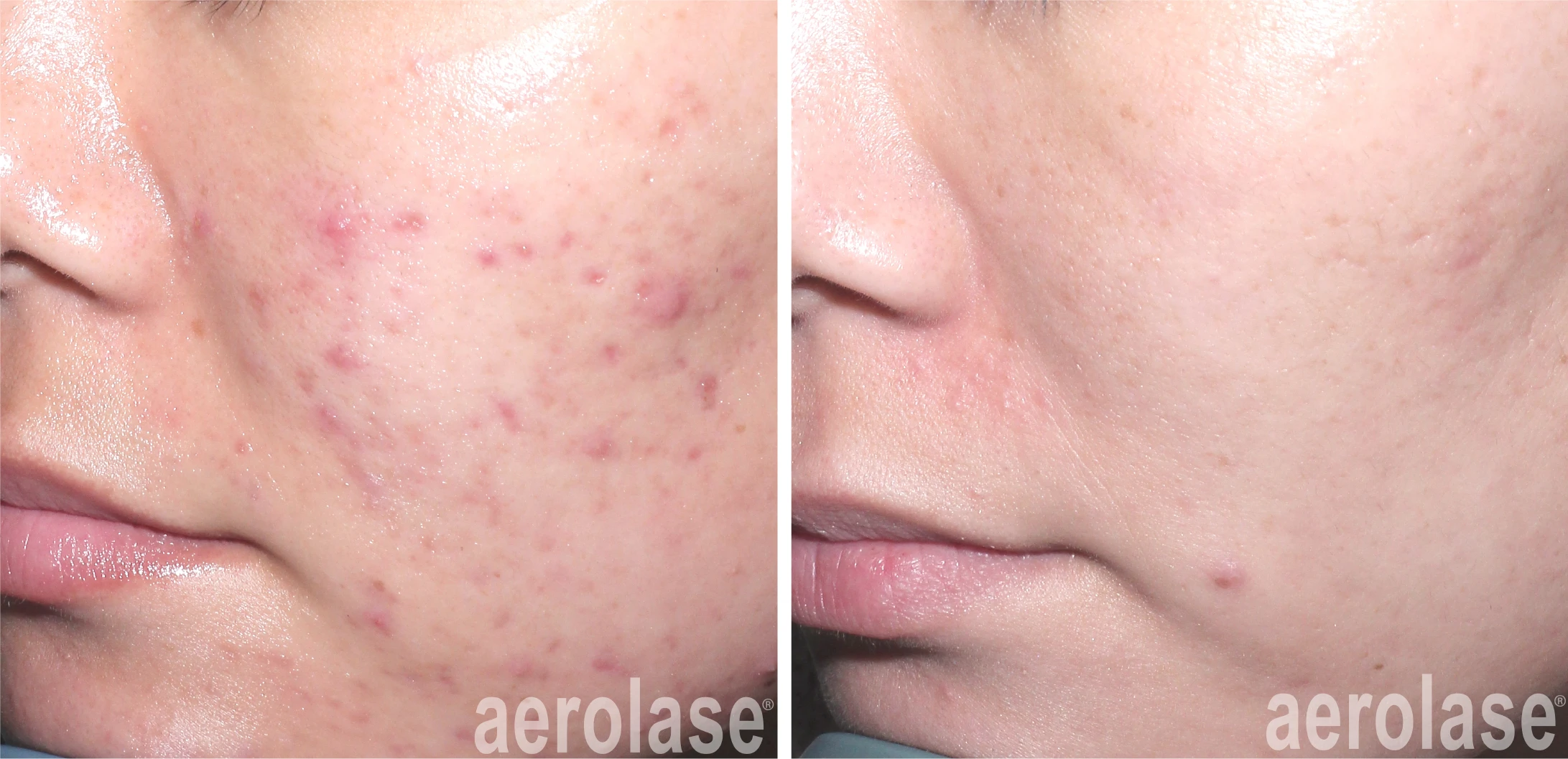 aerolase-acne-spade-before-after-watermark-6-treatments