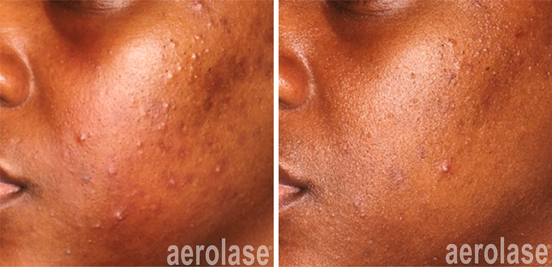 aerolase-before-after-michelle-henry-4-treatments