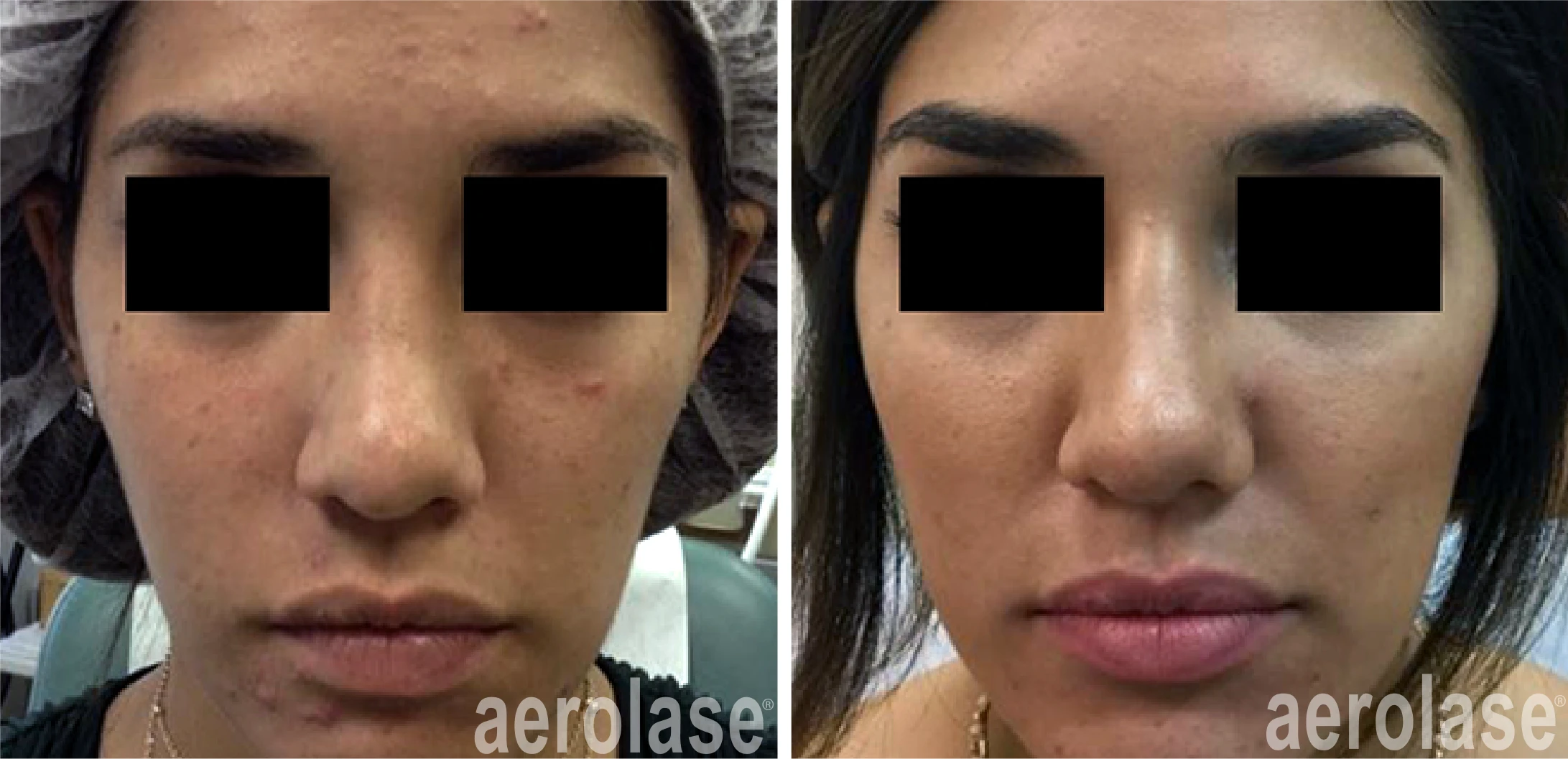 aerolase-mark-nestor-acne-2-months-after-4-treatments