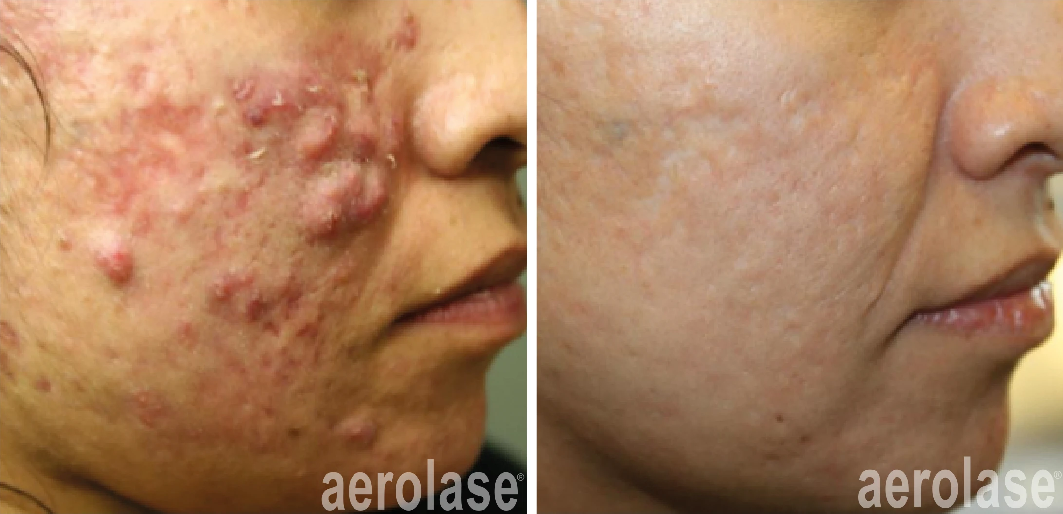 aerolase-michael-gold-acne-5-treatments