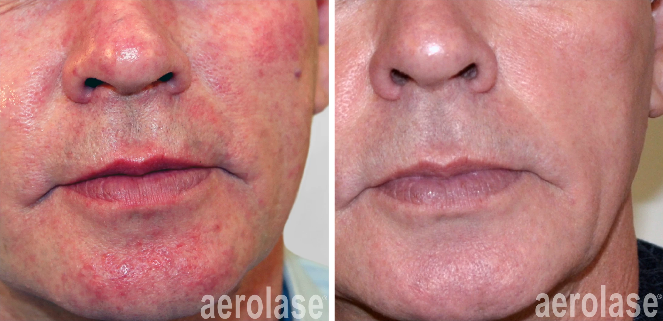 aerolase-neoskin Rosacea - After 2 Treatments - Natalia Geraskova MD