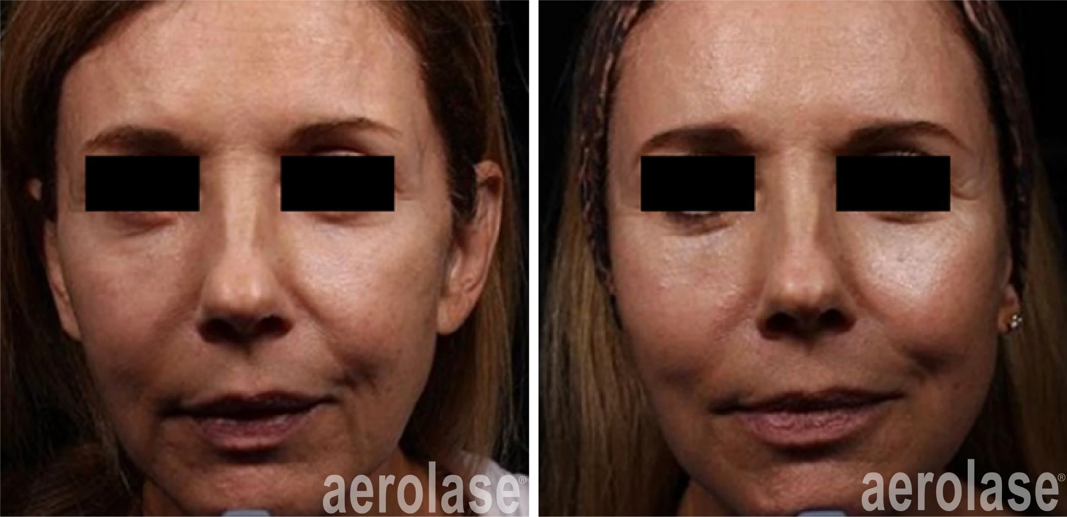 aerolase-neoskin-skin-rejuvenation-after-2-treatments-combined-with-threads-and-filler-one-aesthetics