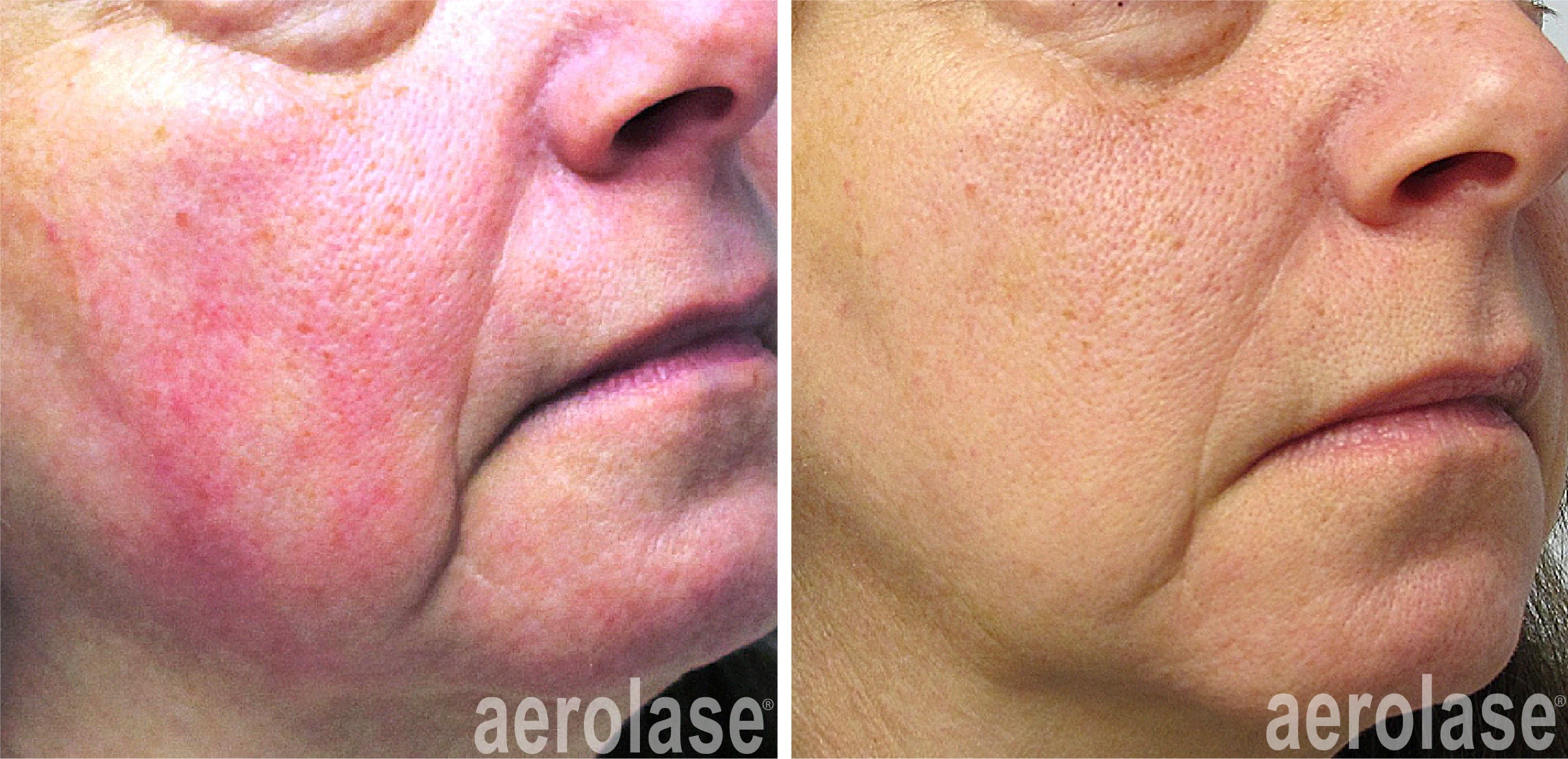 aerolase-rosacea-yelena-kipervas-1-treatment