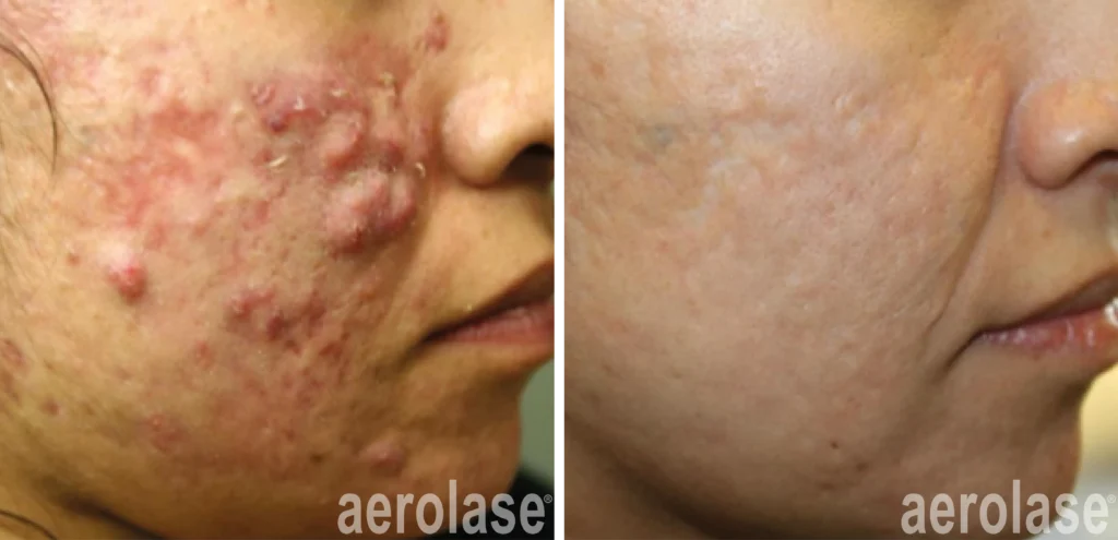 Acne Before & After 1