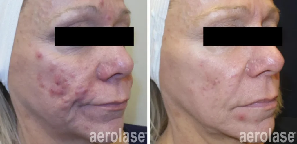 Acne Before & After 3