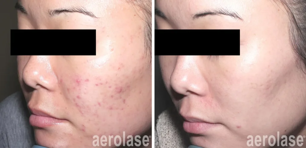 Acne Before & After 4