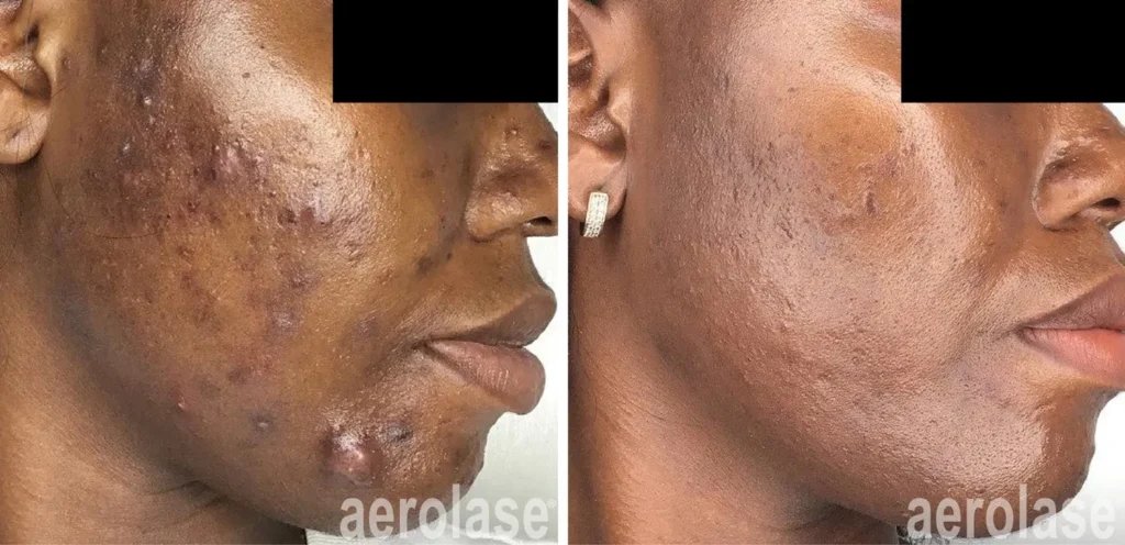 Acne Before & After 5