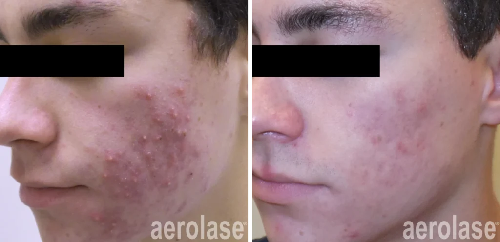 Acne Before & After 6