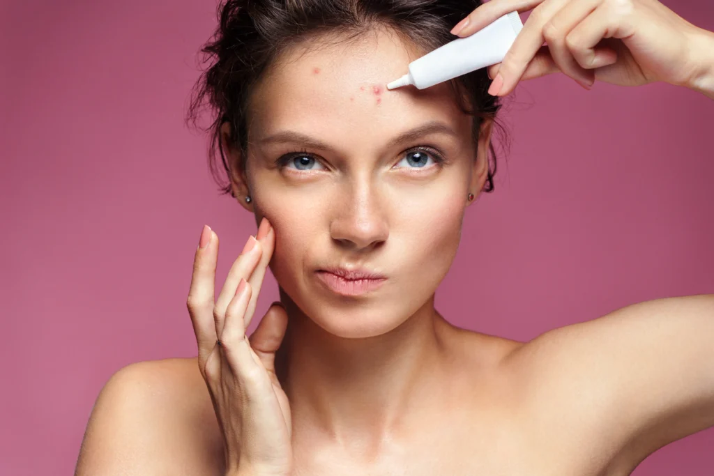 Portfolio 5 Acne Treatment