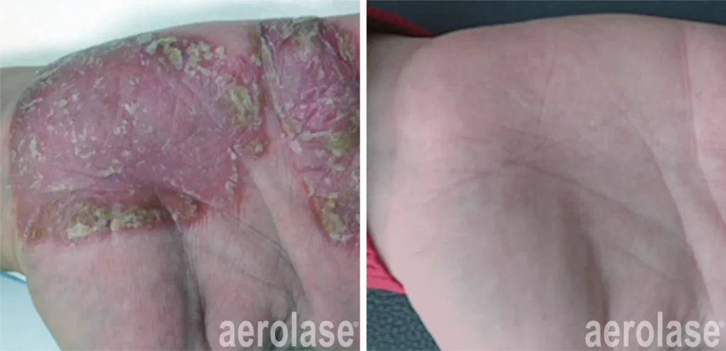 Psoriasis Befoe and Afters 1