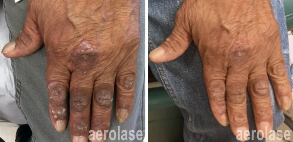 Psoriasis Befoe and Afters 2