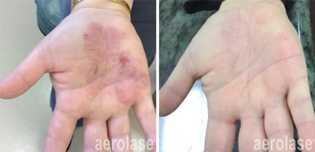 Psoriasis Befoe and Afters 3