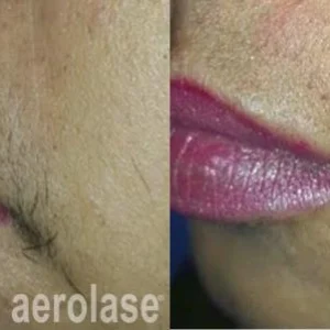 Tesoro Laser Spa - Hair Removal